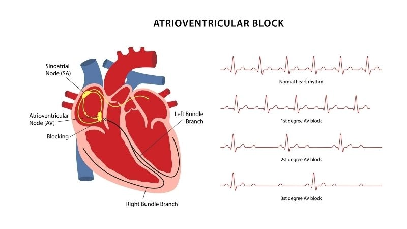 Av block ecg detects hidden electrical problem