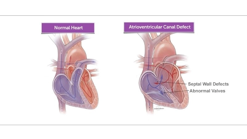 Complete atrioventricular canal defect severe congenital condition