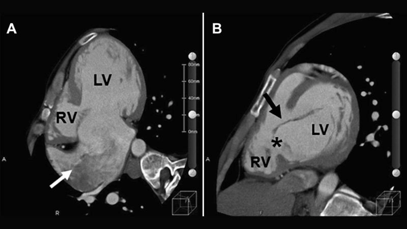 Partial atrioventricular canal defect milder but risky variation
