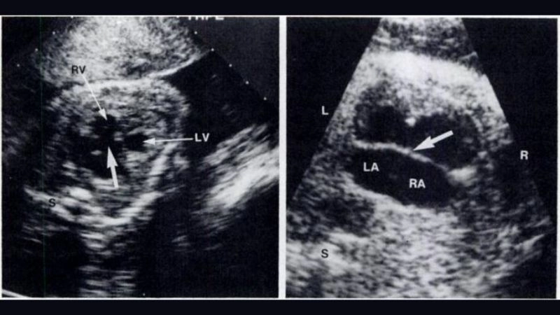 Atrial septal defect hole between upper heart chambers detected