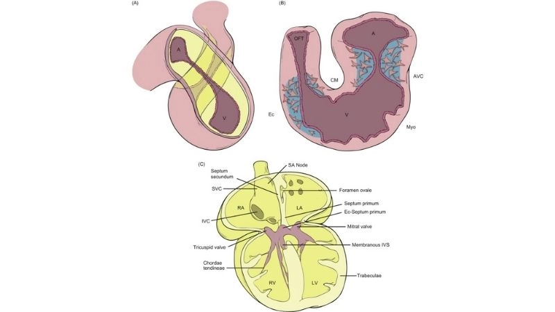 Ventricular septal defect abnormal opening in lower chambers