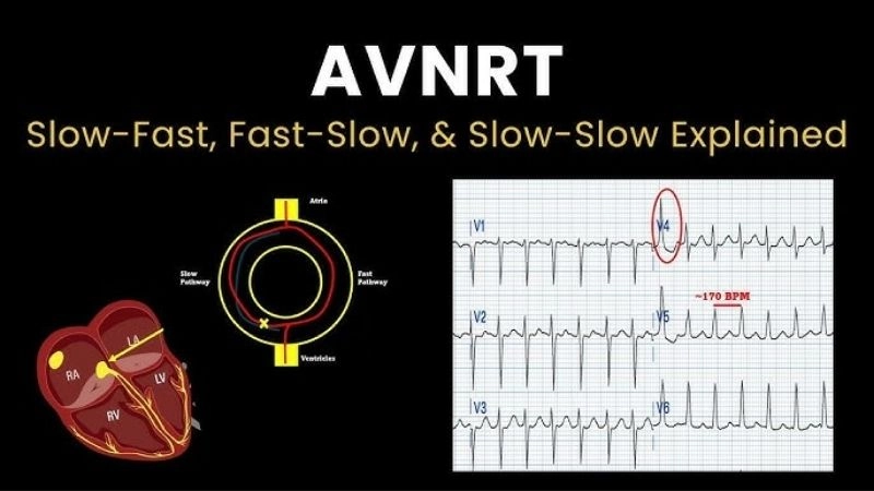 AVNRT common fast rhythm disorder in the heart