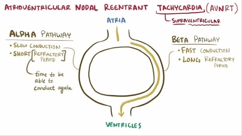Atrioventricular Nodal Reentrant Tachycardia Symptoms show palpitations