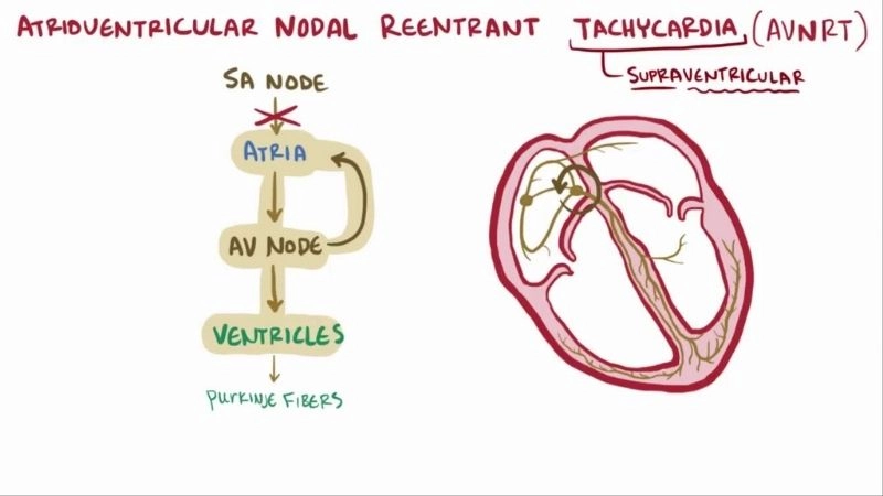 Atrioventricular Nodal Reentrant Tachycardia Treatment restores rhythm