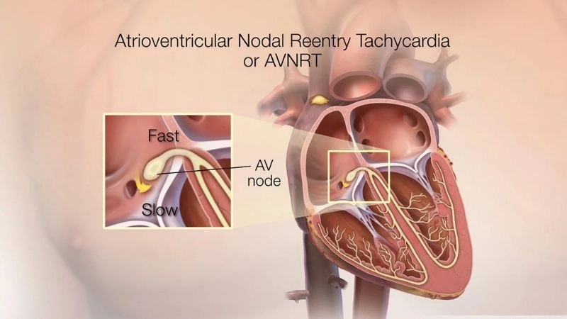 Supraventricular Tachycardia often includes AVNRT type