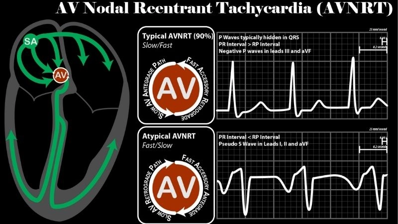 Atrioventricular Nodal Reentrant Tachycardia Catheter Ablation effective cure
