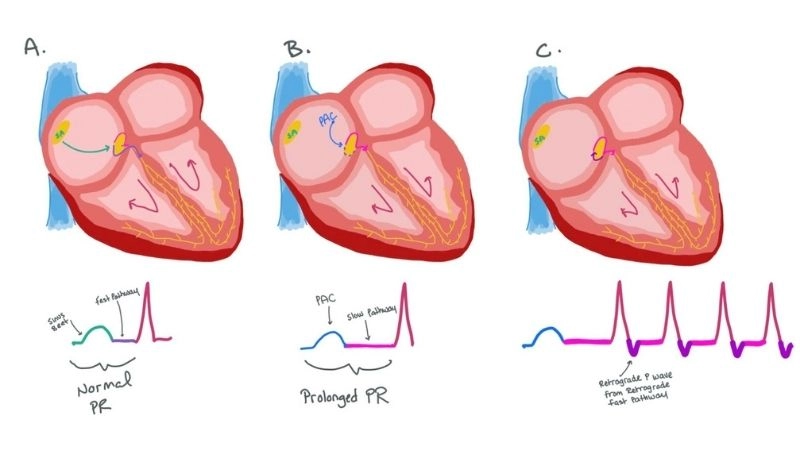 AVNRT In Women shows unique clinical patterns