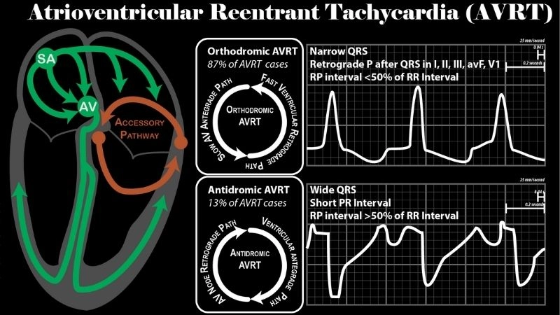 AVRT Symptoms show sudden fast heartbeat episodes