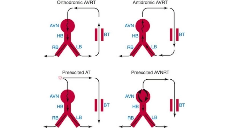 AVRT Causes come from extra electrical pathway