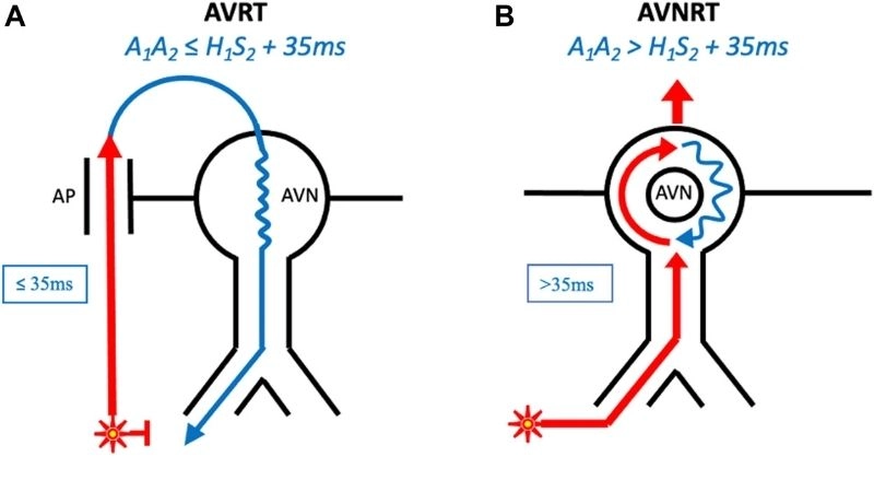 AVRT Ablation provides long term effective solution