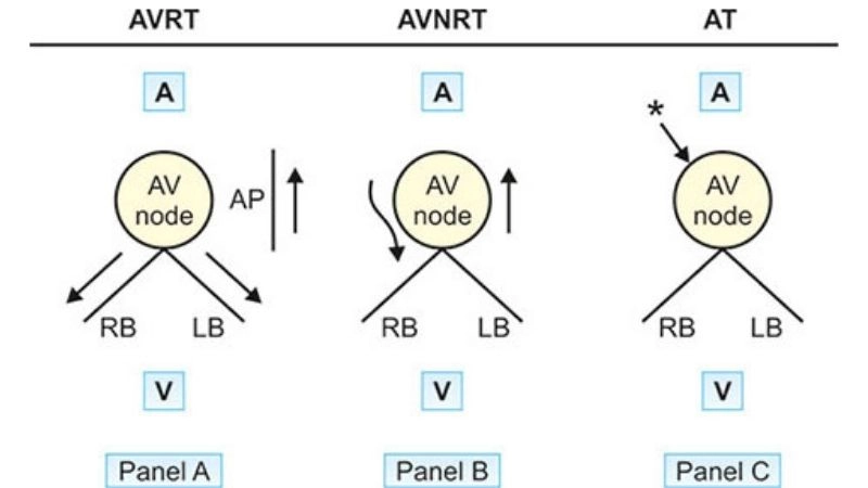 Catheter Ablation For AVRT restores steady heartbeat
