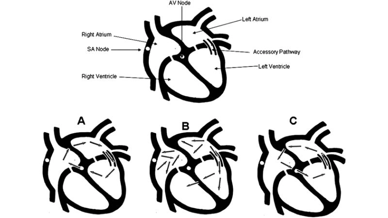 AVRT In Children appears with sudden palpitations