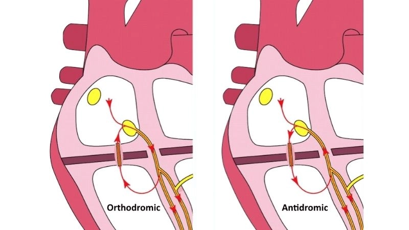 AVRT Diagnosis confirmed with ECG heart tracing