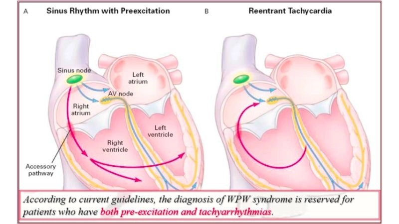 Antidromic AVRT rare pathway with wide QRS
