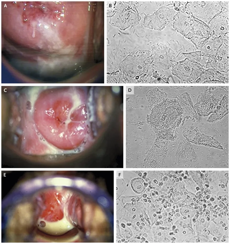 Understanding if BV is a sexually transmitted disease