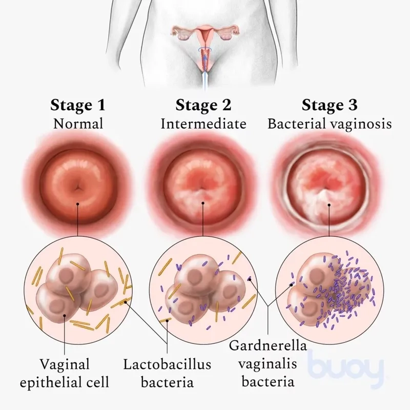 Comparing the signs of BV vs yeast infection