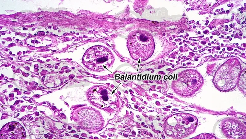 A doctor explaining the treatment for balantidiasis