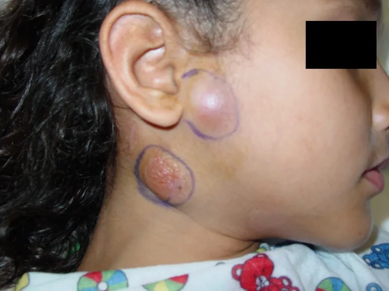 A course of antibiotics for effective Bartonellosis treatment