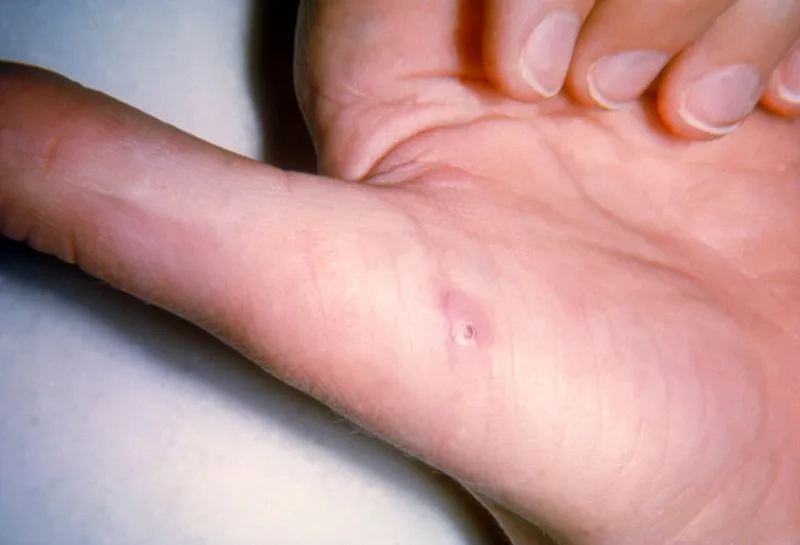 The long-term health impact of chronic Bartonellosis