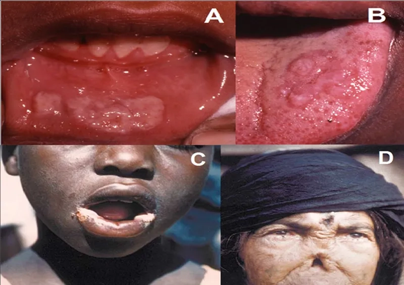 Effective antibiotic treatments for advanced bejel disease