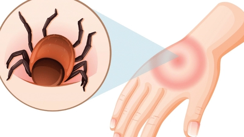 A medical chart showing common Bourbon virus symptoms