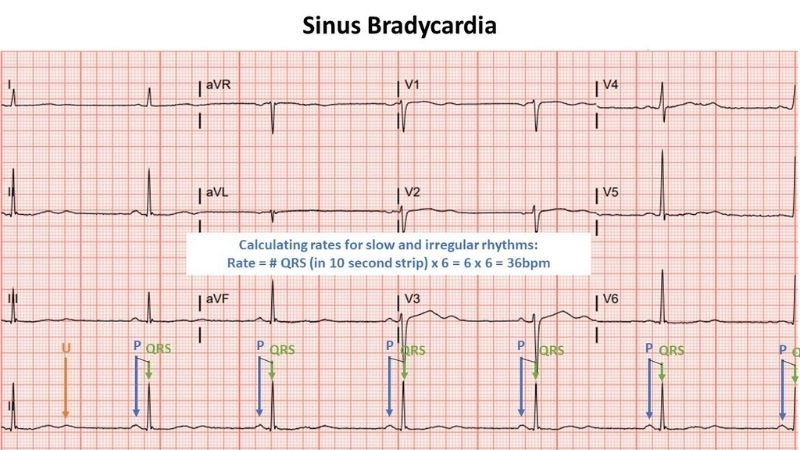 Bradycardia heart rate drops below normal safe levels