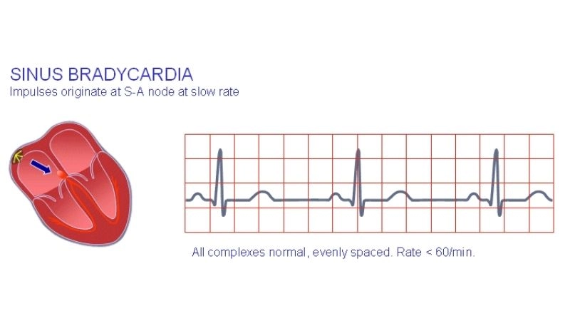 Bradycardia in athletes may be normal due to high fitness