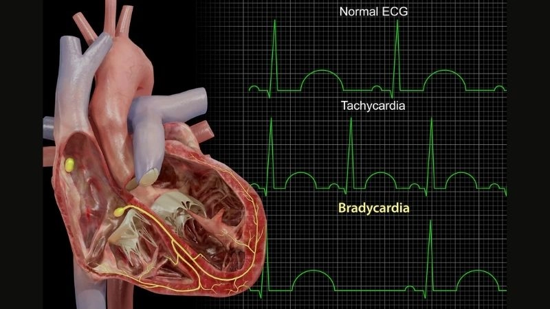 Bradycardia during sleep is often harmless but monitored