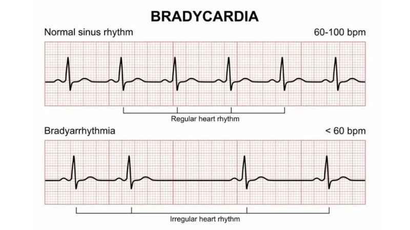 Sinus bradycardia originates from natural pacemaker of heart