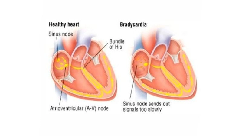 Asymptomatic bradycardia shows slow heart rate without symptoms