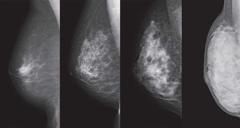 Understanding the cells of triple-negative breast cancer