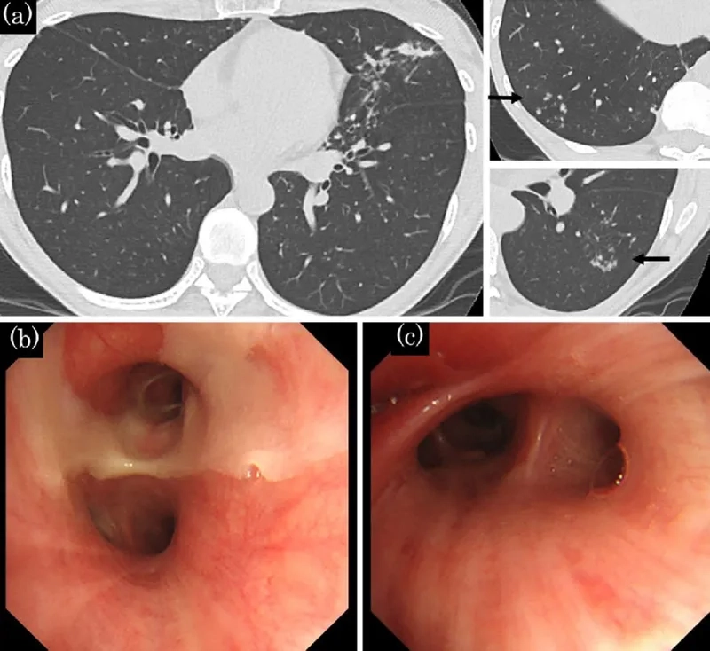 How common is bronchiectasis worldwide