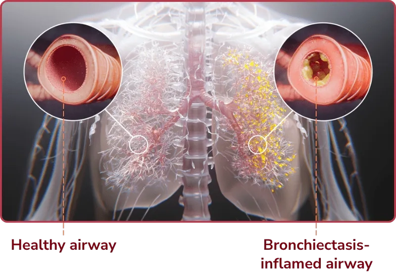 Is bronchiectasis the same as bronchitis