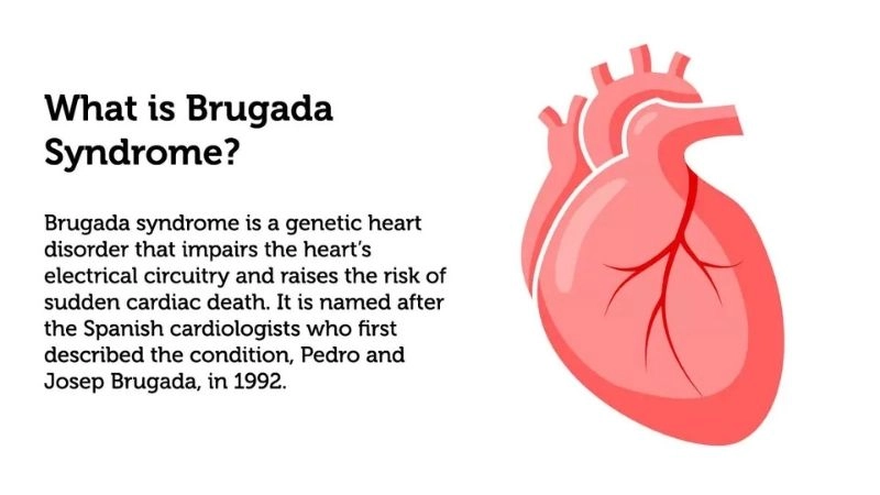 Brugada Syndrome ECG reveals unique pattern change