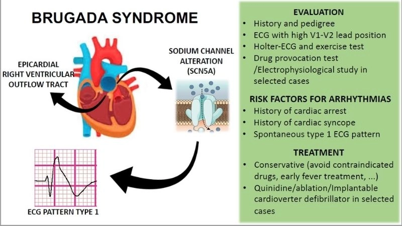 Brugada Syndrome Diagnosis confirms cardiac disorder