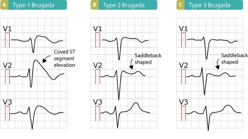 Brugada Syndrome Genetics linked with inherited risks