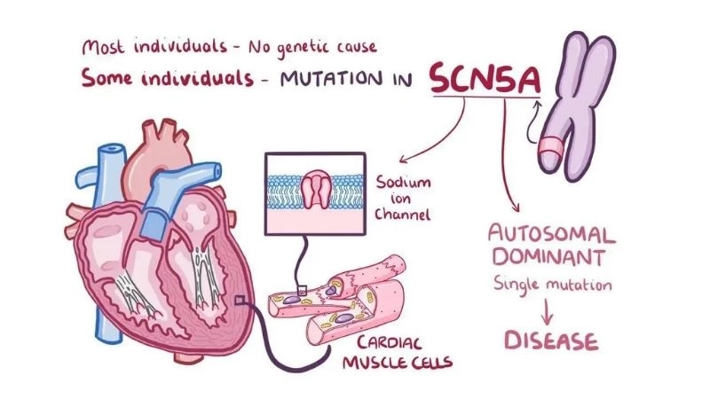 Brugada Syndrome And Sudden Cardiac Death raise alarm