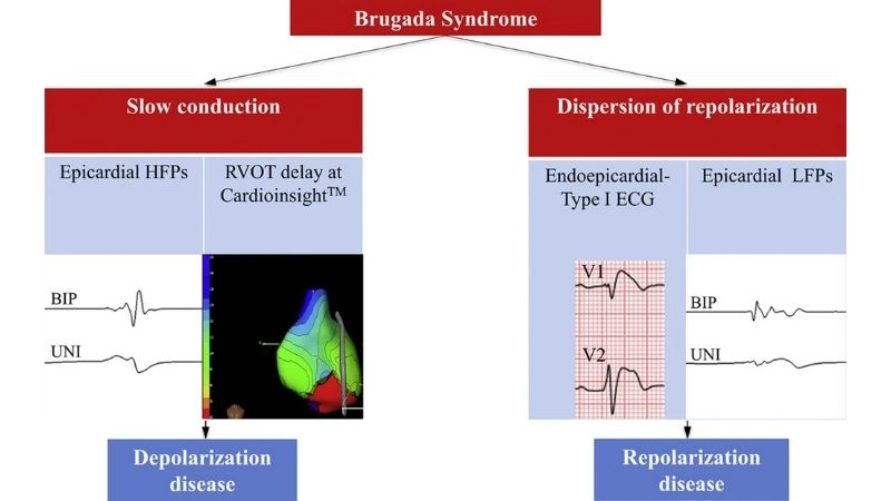 Brugada Syndrome ICD device protects against arrhythmia