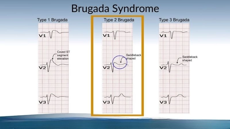 Brugada Syndrome In Women shows different outcomes