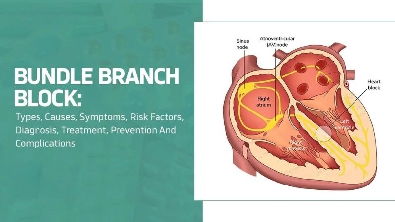 Bundle Branch Block Symptoms reveal hidden heart issues