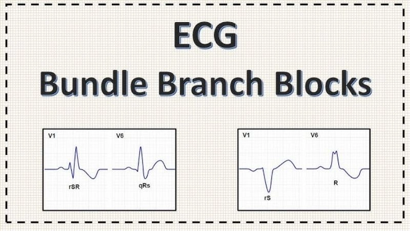 Incomplete Bundle Branch Block mild signal disruption