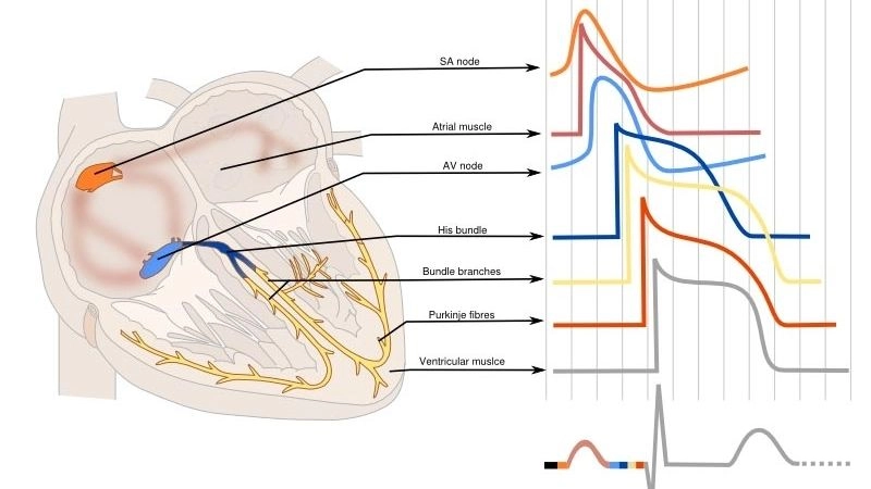 Bundle Branch Block Treatment improves cardiac function