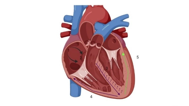 Bundle Branch Block And Exercise impact heart rhythm