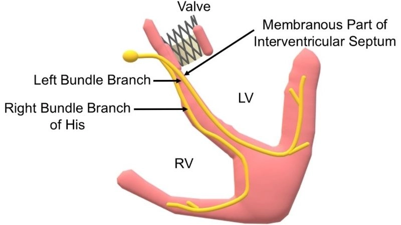 Bundle Branch Block And Heart Attack raise danger
