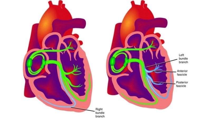 Bundle Branch Block In Athletes signals risk factor