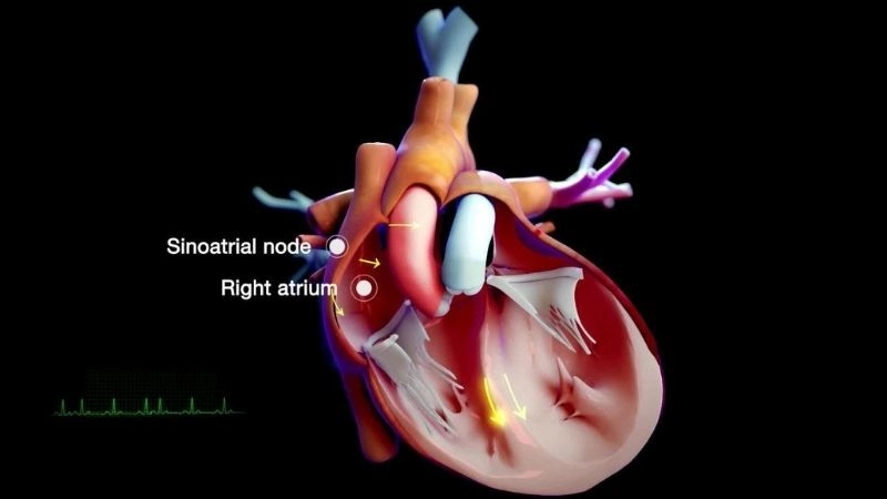 Bundle Branch Block And Pacemaker support steady beat
