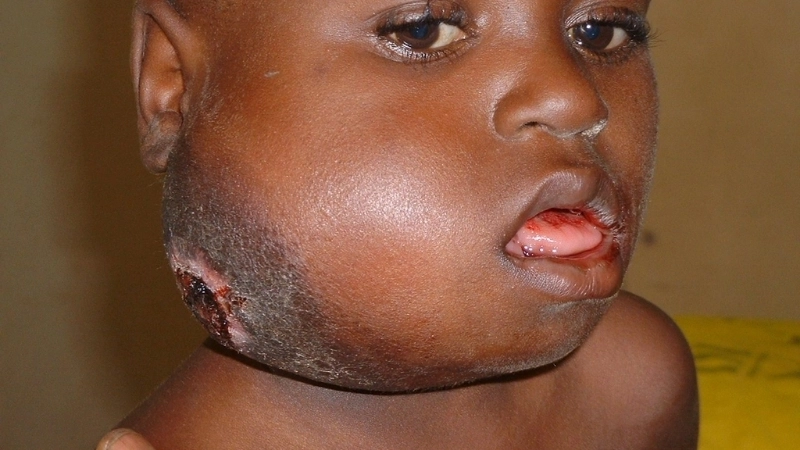 Burkitt's Lymphoma symptoms show fast