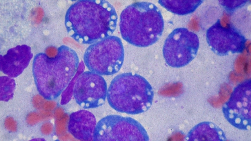 Burkitt's Lymphoma symptoms guide clear