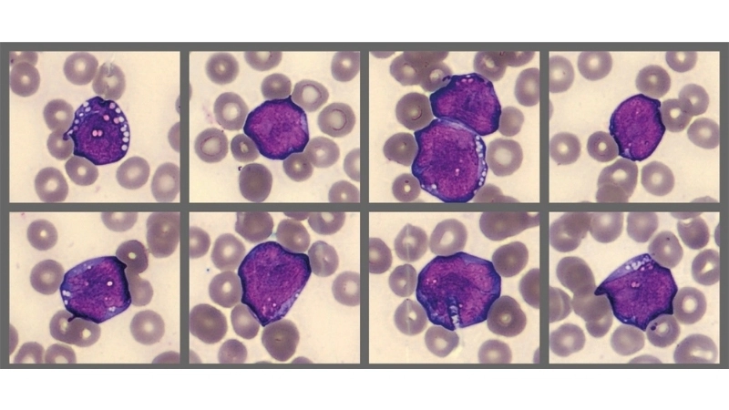 Burkitt's Lymphoma treatment insights