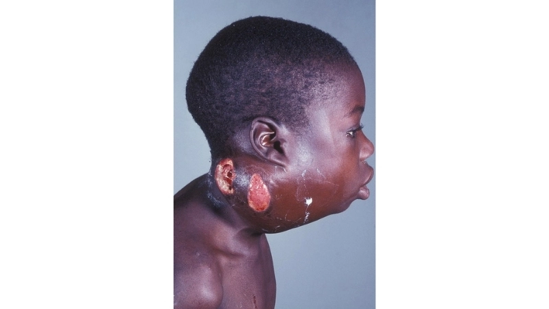 Burkitt's Lymphoma prognosis overview